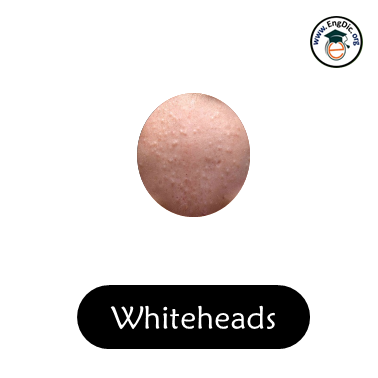 whiteheads