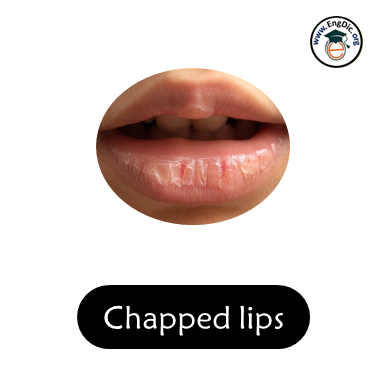 chapped lips