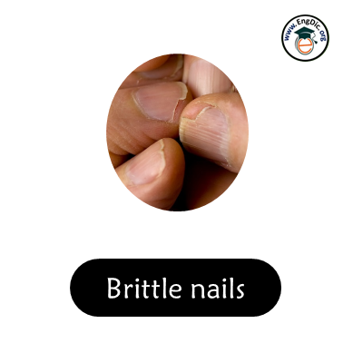 brittle nails